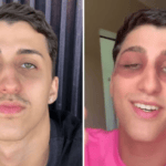 Gustavo - hematomas nos olhos