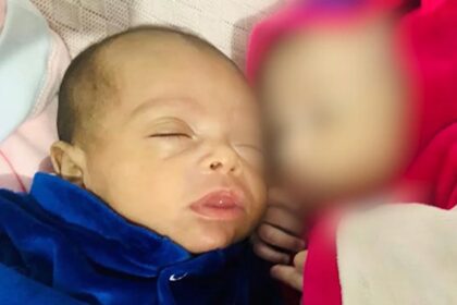 Bento, que deu entrada no hospital com queimaduras, múltiplas fraturas e traumatismo craniano; irmã gêmea também apresentava marcas de agressão