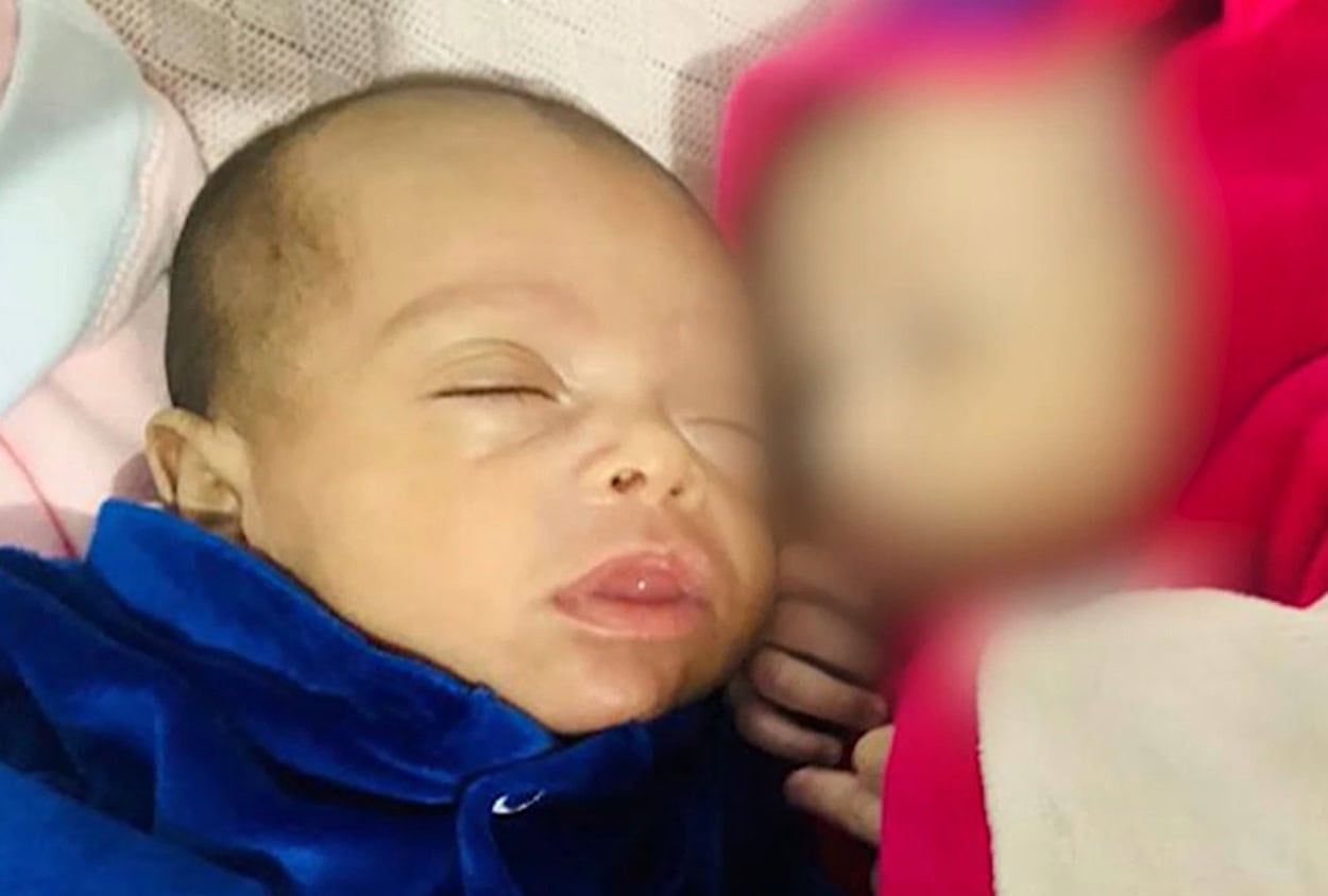Bento, que deu entrada no hospital com queimaduras, múltiplas fraturas e traumatismo craniano; irmã gêmea também apresentava marcas de agressão 