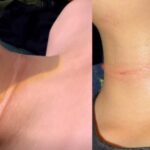 Menino de 9 anos sofre corte no pescoço por linha com cerol enquanto brincava em praça de São Bernardo