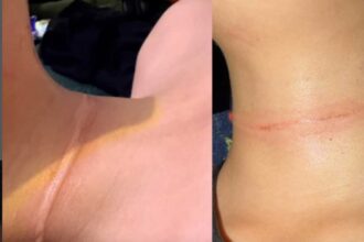 Menino de 9 anos sofre corte no pescoço por linha com cerol enquanto brincava em praça de São Bernardo