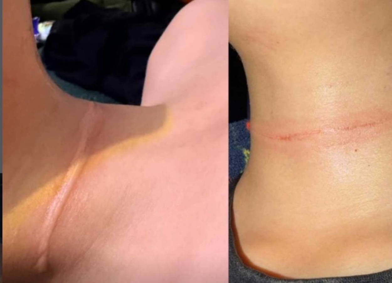 Menino de 9 anos sofre corte no pescoço por linha com cerol enquanto brincava em praça de São Bernardo