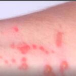 Santo André confirma cinco casos de Mpox em 2026; paciente mais recente é uma mulher de 34 anos