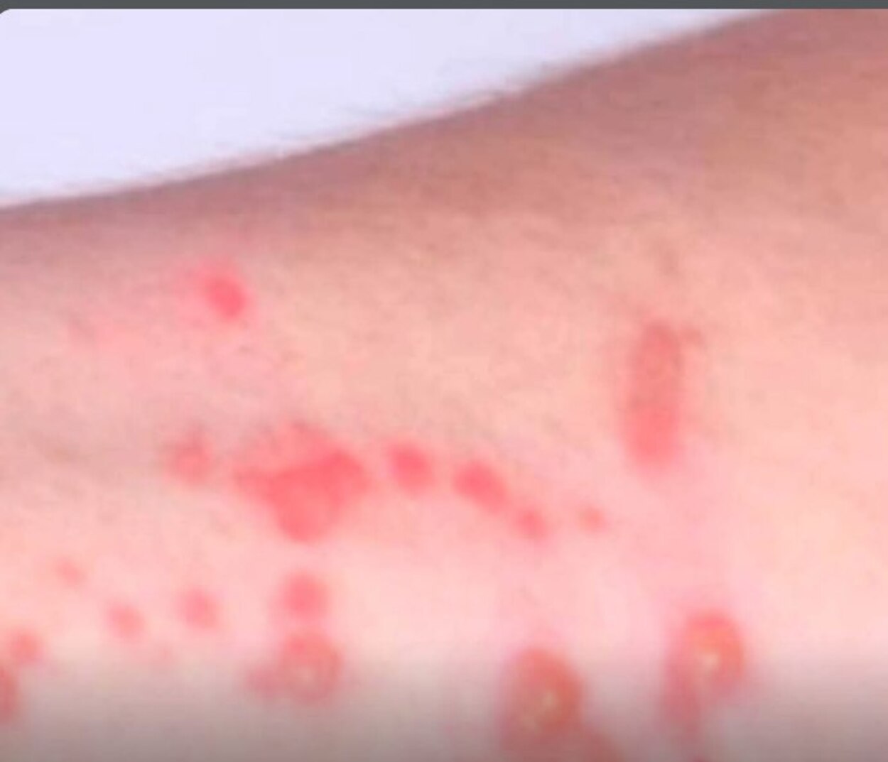 Santo André confirma cinco casos de Mpox em 2026; paciente mais recente é uma mulher de 34 anos